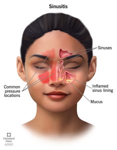 Sinus Infection (Sinusitis)